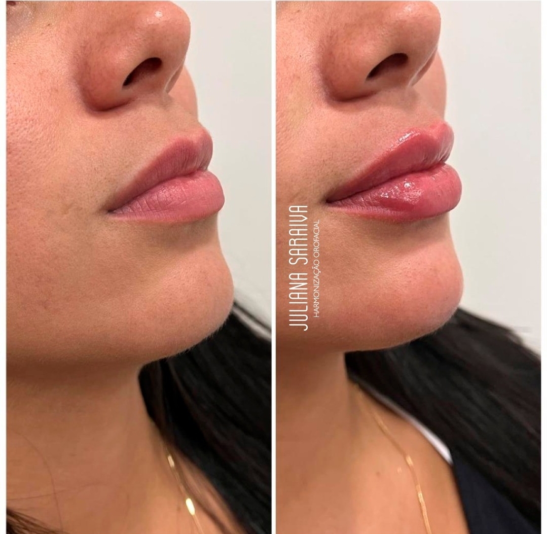 Antes e Depois do Preenchimento Labial em Cabo Frio: